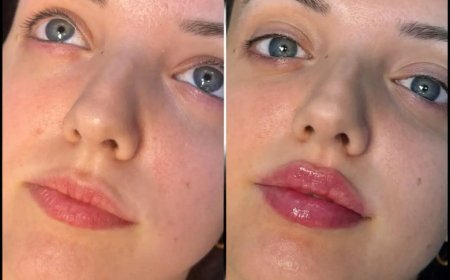 Achieve Natural-Looking Results with the Best Doctors in Dubai for Fillers