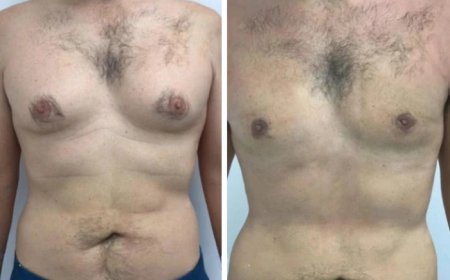 What Makes Gynecomastia in Dubai Surgery Different from Other Countries
