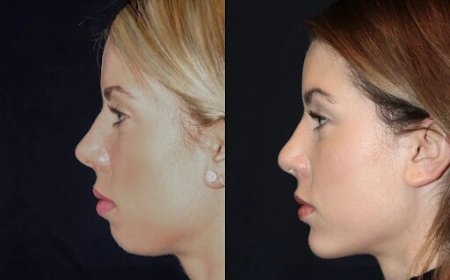 Best Aesthetic Clinic in dubai for Chin Fillers: Long-Lasting Results