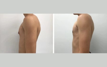 How to Identify the Best Gynecomastia Surgeon in Dubai for Your Body Type