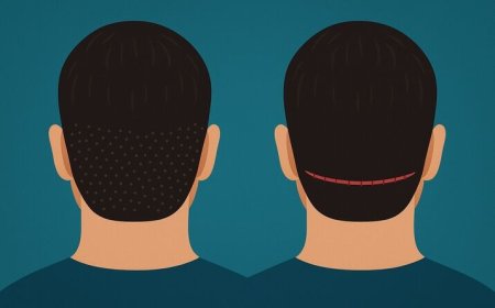Pakistan Best Hair Transplant Techniques: FUE vs FUT