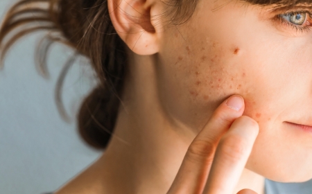 What You Should Know About Weed and Skin Breakouts