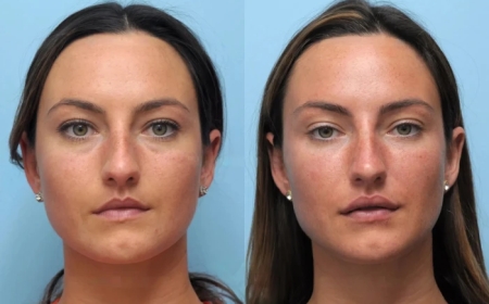 Best Plastic Surgeon in Dubai for Thread Lift: Transform Without Surgery